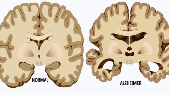 alzheimer-causes-FI-800x420