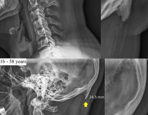 cranio_con_punte_ossee_8daedbcd9e07727bcc8483080bbc5a36