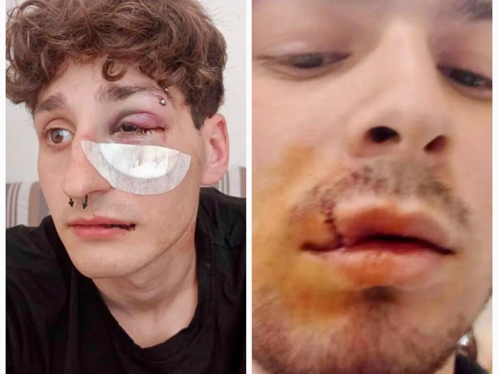 Napoli, pestati per una birra rovesciata: due giovani in ospedale, uno è disabile.