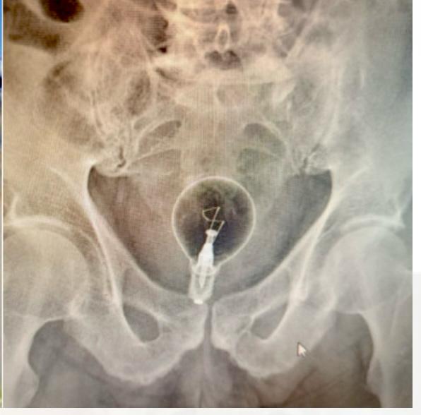 “Lecce, anziano finisce in ospedale con una lampadina… letteralmente nel posto sbagliato”