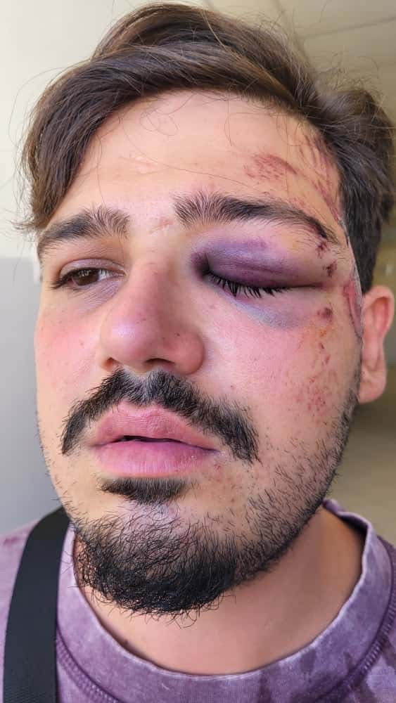 Napoli, ciclista investito da un pirata della strada nella Galleria Vittoria: polemiche sulle telecamere non funzionanti