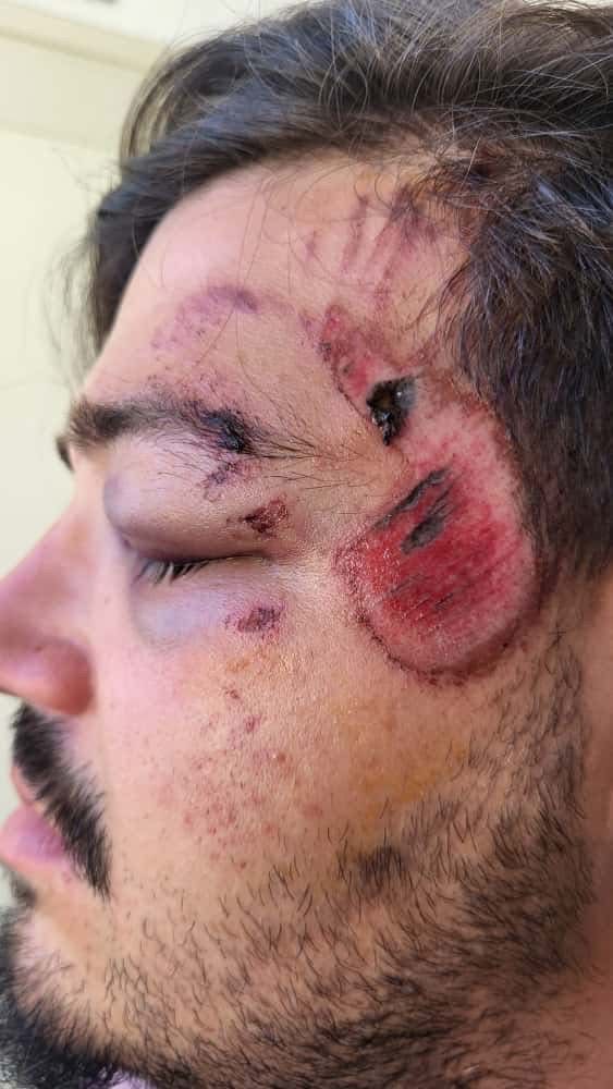 Napoli, ciclista investito da un pirata della strada nella Galleria Vittoria: polemiche sulle telecamere non funzionanti