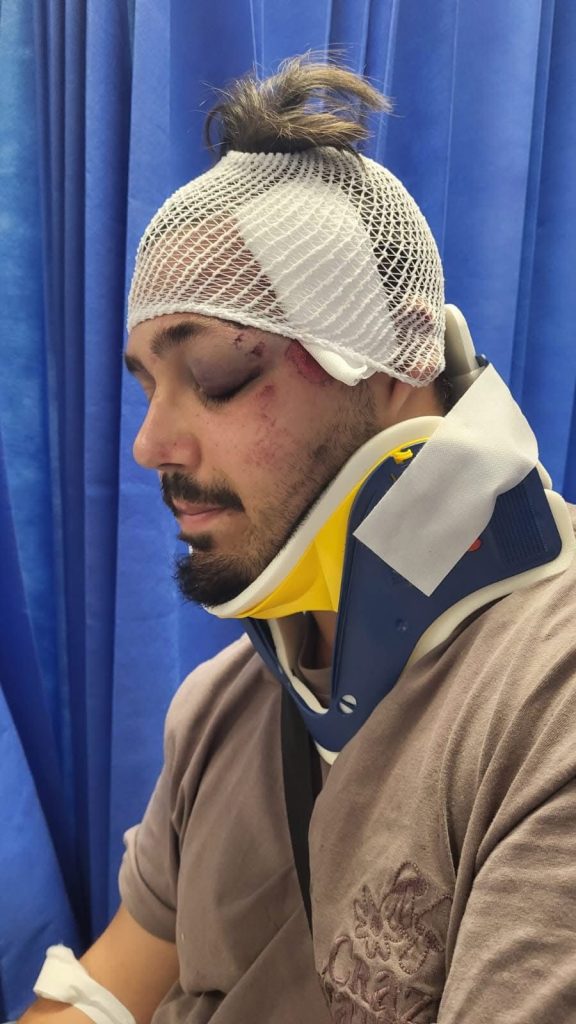 Napoli, ciclista investito da un pirata della strada nella Galleria Vittoria: polemiche sulle telecamere non funzionanti