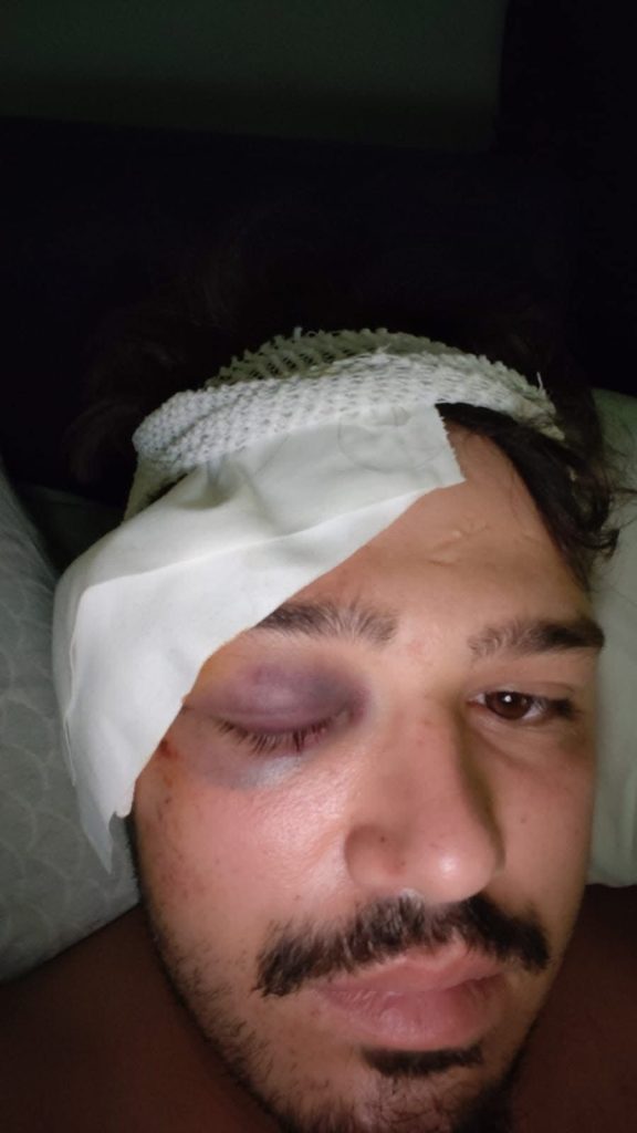 Napoli, ciclista investito da un pirata della strada nella Galleria Vittoria: polemiche sulle telecamere non funzionanti