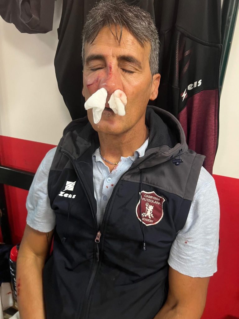 Aggredito il presidente della Puteolana: frattura al setto nasale, sarà operato. “Una vergogna, doveva essere una giornata di festa”