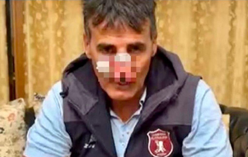 Aggredito il presidente della Puteolana: frattura al setto nasale, sarà operato. “Una vergogna, doveva essere una giornata di festa”