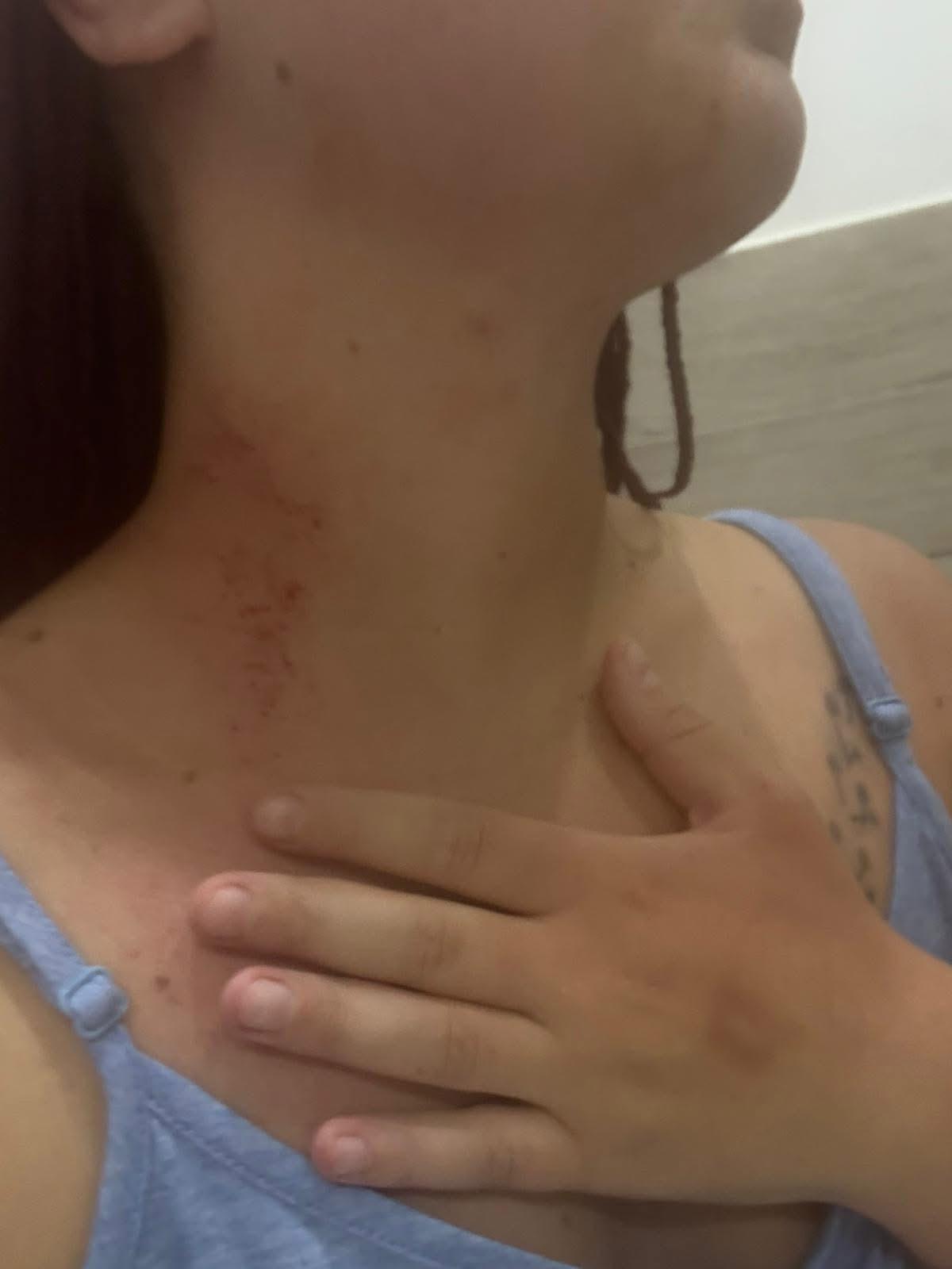 Brusciano, donna massacrata dal marito: salvata in extremis grazie alla figlia. Borrelli (AVS): “Servono pene certe e protezione immediata per chi trova il coraggio di denunciare”